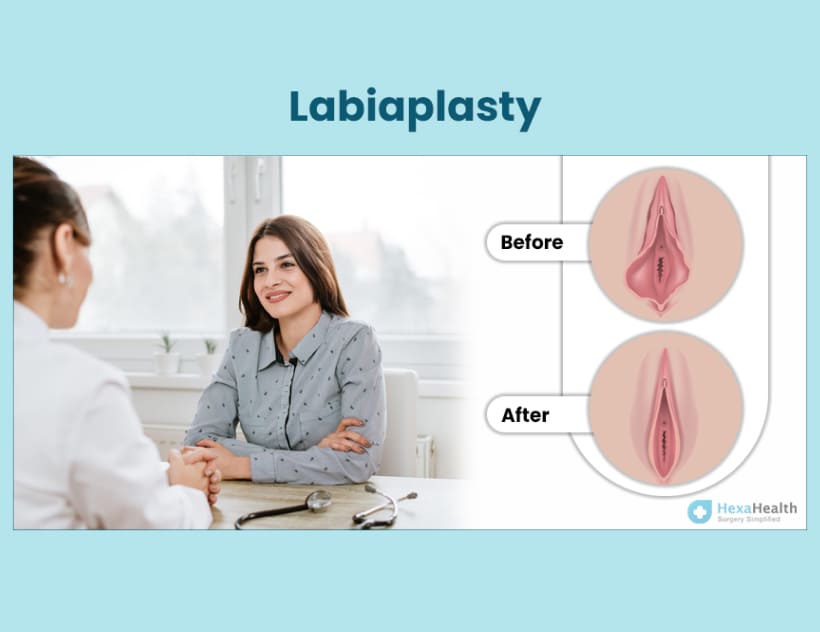 Benefits of Labiaplasty